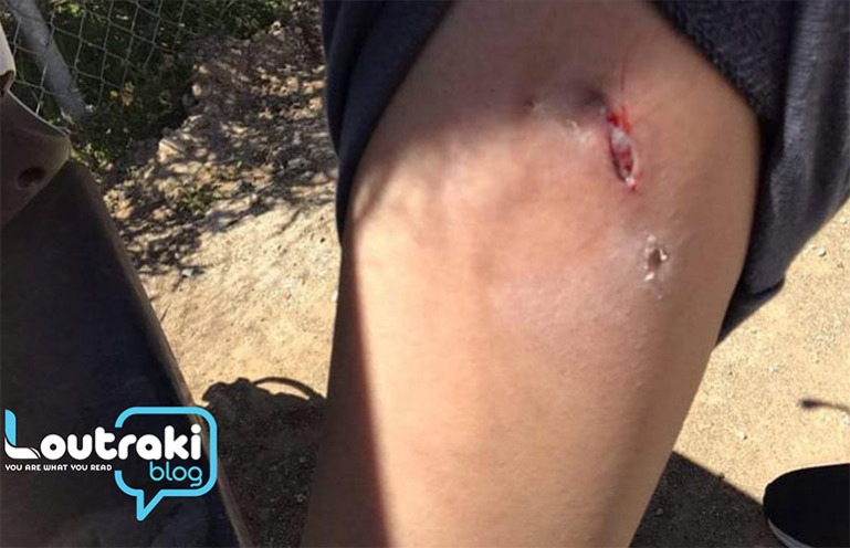 Λουτράκι: Αδέσποτο σκυλί δάγκωσε 15χρονο κορίτσι